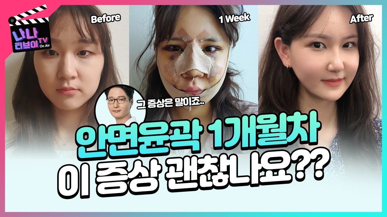 [안면 윤곽 Q&A] 윤곽 3종(앞턱 옆광대 사각턱) 1개월차인데 궁금한 게 너무 많아요😶 아버지! 정답을 알려줘~