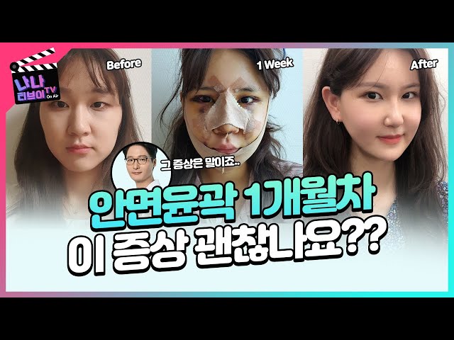 [안면 윤곽 Q&A] 윤곽 3종(앞턱 옆광대 사각턱) 1개월차인데 궁금한 게 너무 많아요😶 아버지! 정답을 알려줘~