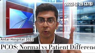 PCOS: Comparisons & Discussion- Antai Hospitals