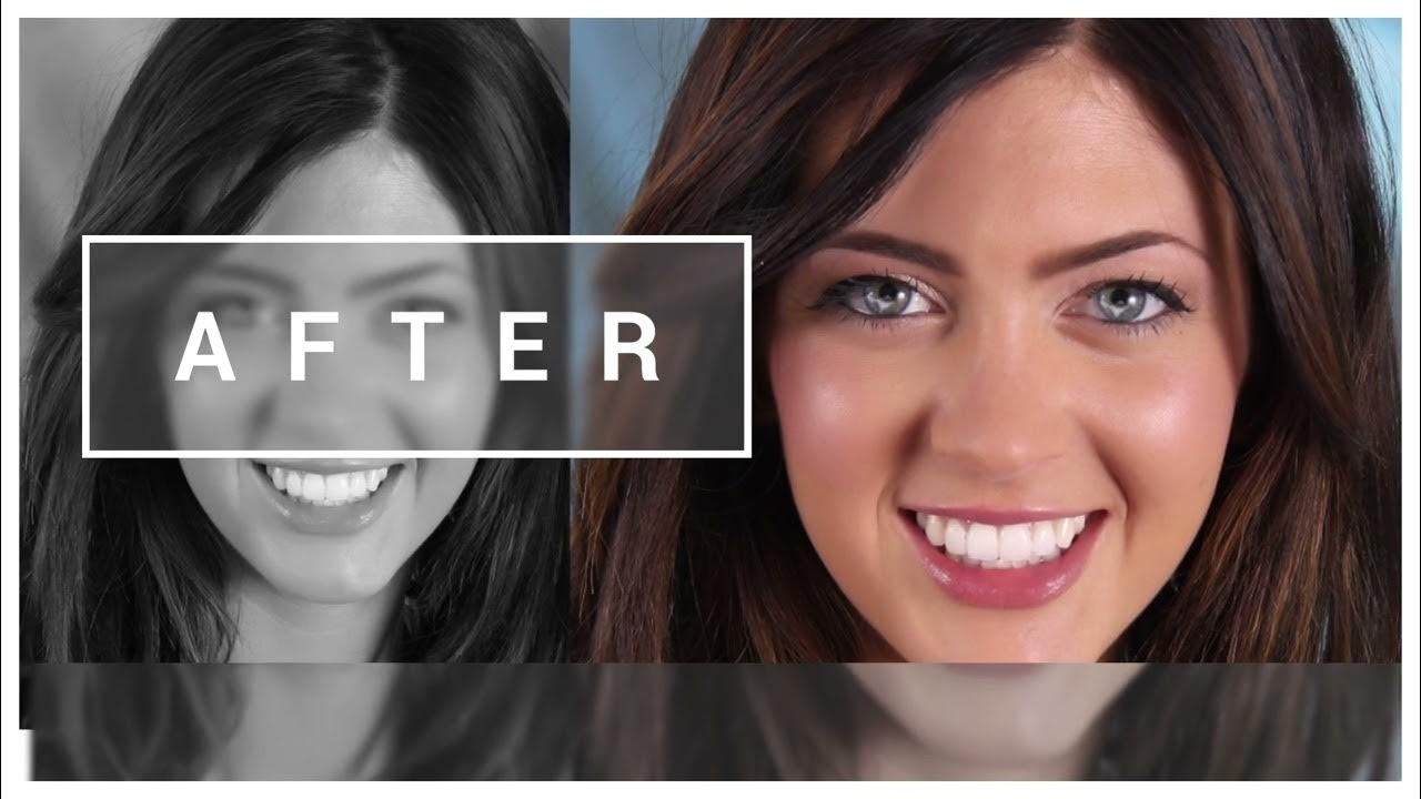 Salin Dentistry The Best Veneers Dentist in Bakersfield! YouTube