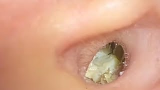 ASMR Ear Cleaning – A Hidden Wax Cave Finally Uncovered!