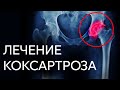 ЛЕЧЕНИЕ КОКСАРТРОЗА | Доктор Черкасов