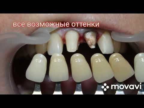 Безметалловая керамика. Центральные зубы - YouTube