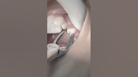 Extraction of first premolar for orthodontic treatment #satisfying