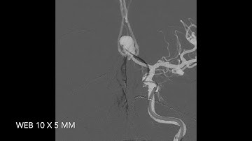 WEB device for ruptured 12 mm AcomA aneurysm