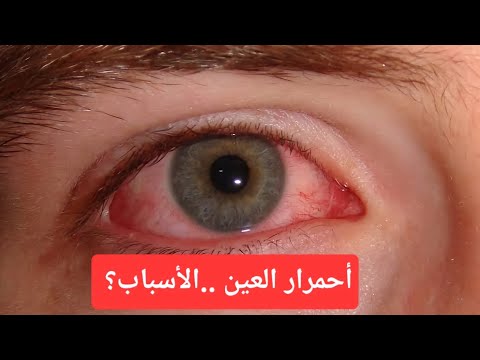 احمرار العين أسبابه