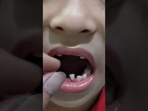 Video: Cách Nhổ Răng Không Cần Tăm: 6 Bước