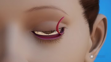 Entropion and Ectropion Repair Surgeries