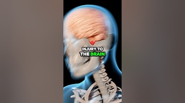 What happens when you have a concussion? 🧠