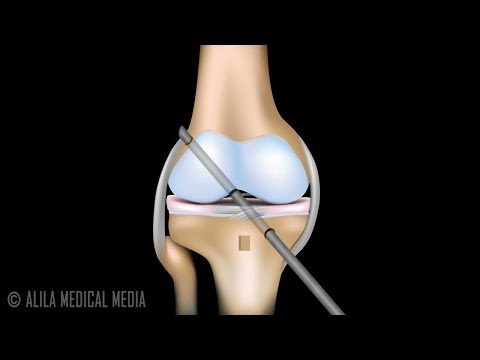 ACL Reconstruction Surgery Animation.