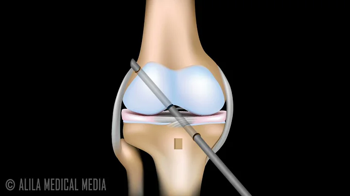 ACL Reconstruction Surgery Animation. - DayDayNews