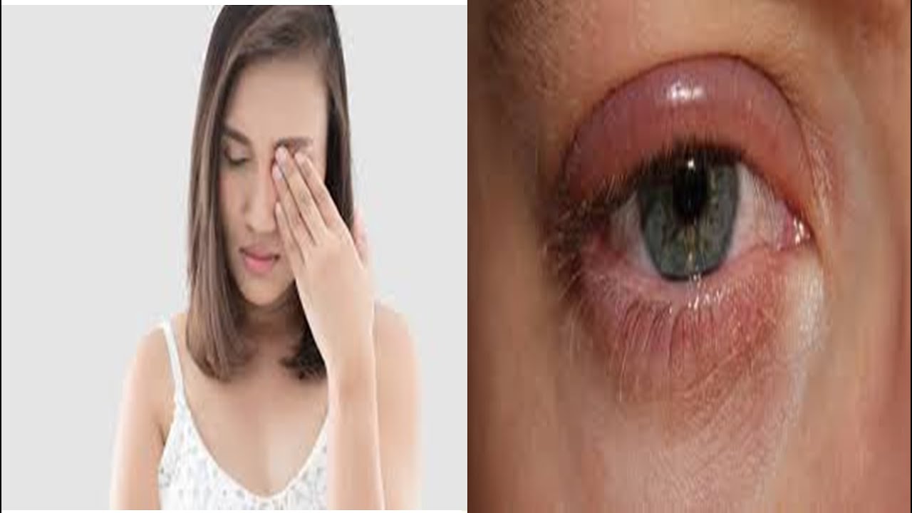 3 remédios caseiros para desinchar os olhos! - YouTube