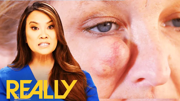 A Massive Cyst Is Blocking Off This Patient's Visi...