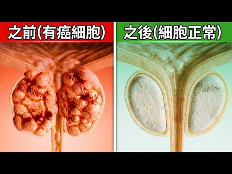 (癌症飲食訪談)抗癌飲食該吃什麼？最壞癌症,轉到最佳情況(沒癌症),自然療法,柏格醫生 Dr Berg