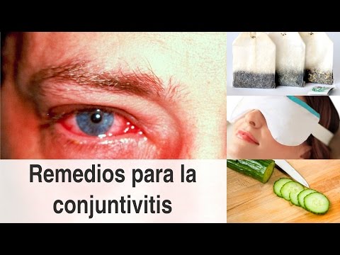 Vídeo: Los Mejores Remedios Para La Conjuntivitis: Tratamientos Médicos Y Naturales