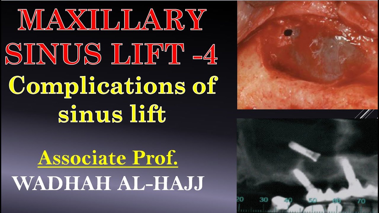 22 Sinus lift 4 Complications. Dr Wadhah implantology lectures. د