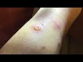 水ぶくれが潰れるとこうなる(ノミ)