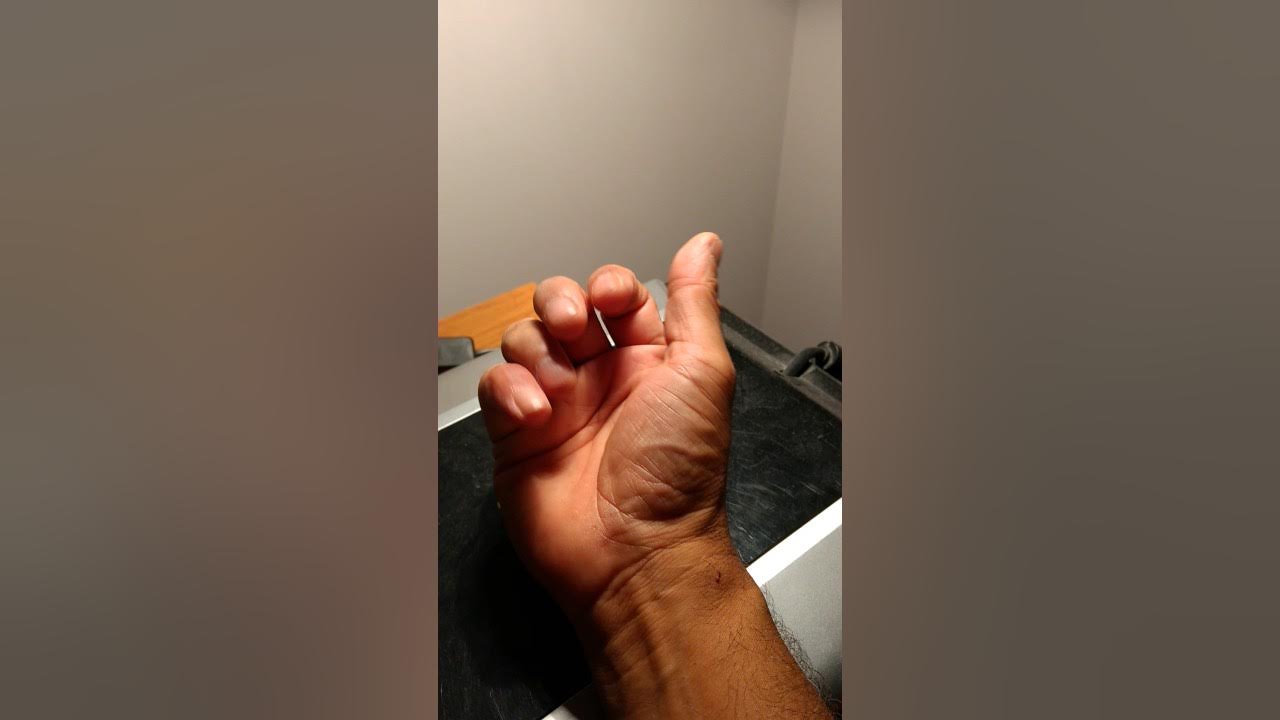 Simple rehabilitation for mallet finger after partial removal of splint