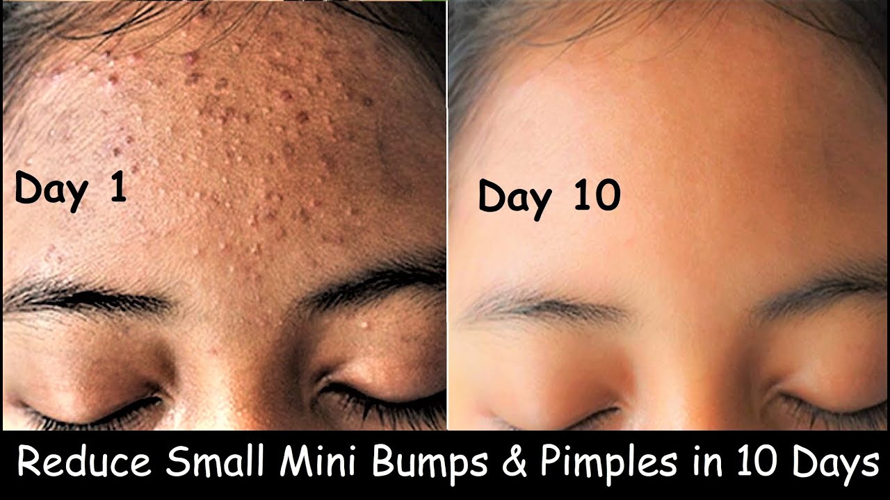 Get rid of Tiny Bumps on Face - Small head bumps & Pimples Clear Skin w...