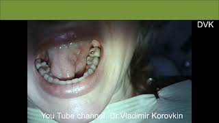 Lokalanästhesie zur Behandlung von 34,35 Zähnen.