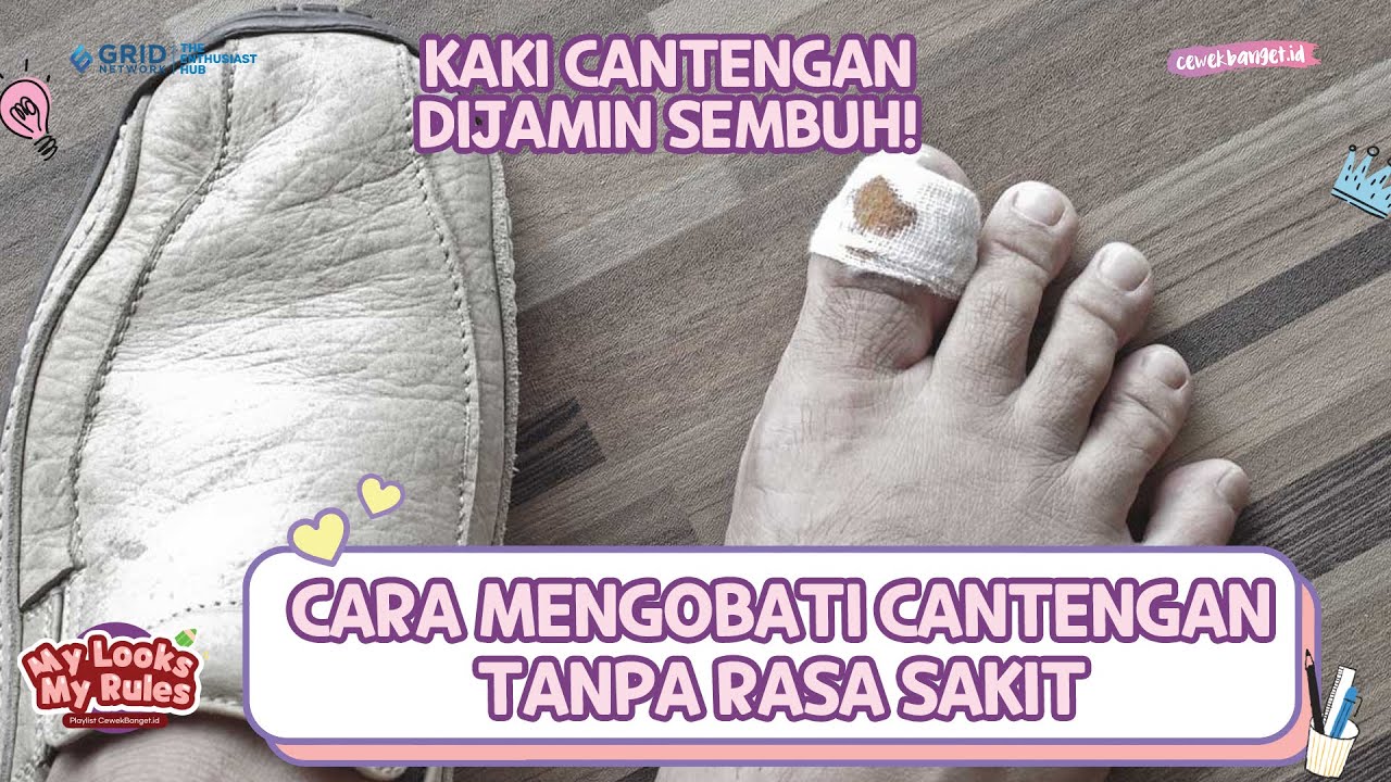 Cara Menghilangkan dan Mengobati Cantengan dengan Aman Tanpa Rasa Sakit