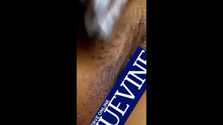 Blackhead and ingrown hair removal in the vaginal area Part 1