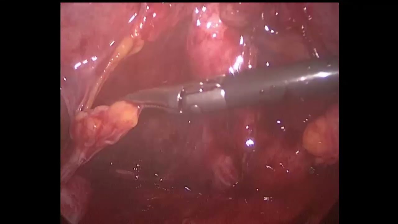 difficult laparoscopic cholecystectomy