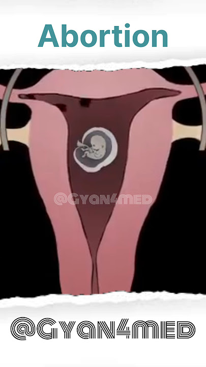 Animasi Aborsi