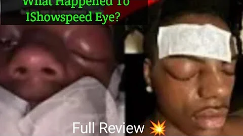 IShowSpeed Eye Injury : What Happened To IShowspeed Eye? YouTuber Reveals Condition Causing Health