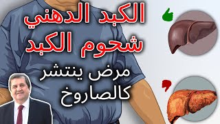 الكبد الدهني , د غسان الفقيه , شحوم الكبد ,fatty liver , علاج الكبد الدهني , انزيمات الكبد ,السكري