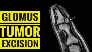 Excision of Glomus Tumour 