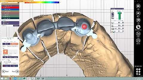 How to design interlock in exocad