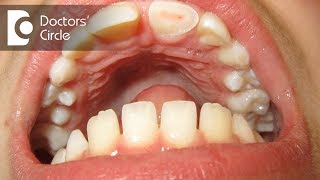 What happens when dental pulp gets injured? - Dr. Sowmya Vijapure