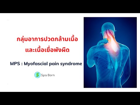 กลุ่มอาการปวดกล้ามเนื้อและเนื้อเยื่อพังผืด MPS (Myofascial pain syndrome)