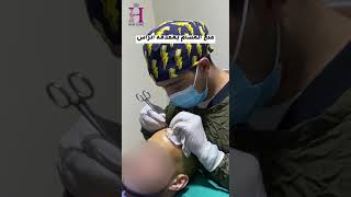 زراعة_الشعر الطبيعى لحالة صلع من الدرجة ال 6