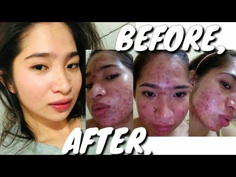 PIMPLE BREAKOUT  | THE SCARS ARE BEAUTIFUL ❤️