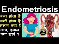 What is Endometriosis, in Hindi, Symptoms, Treatment, Diet, Surgery, Occurs, Affects fertility