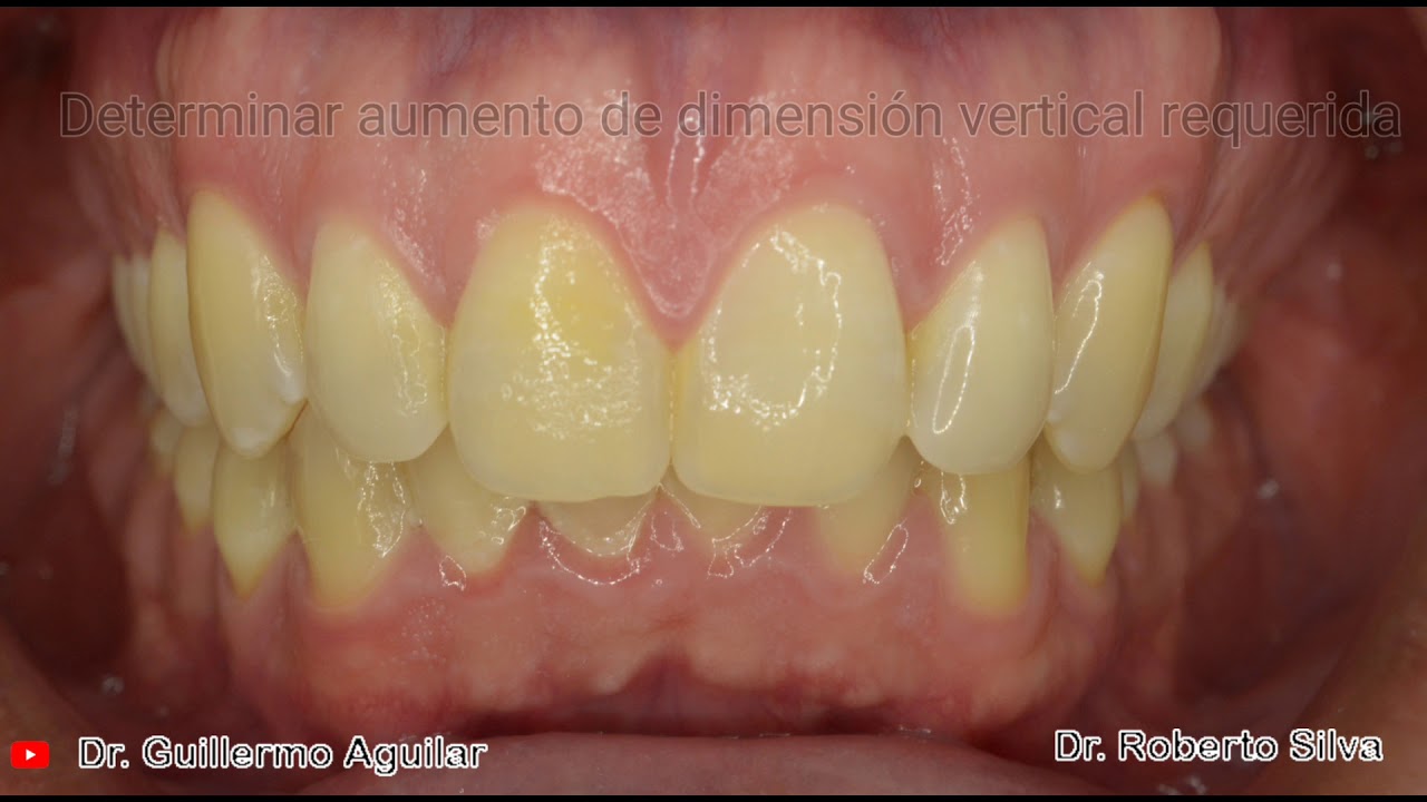 Elaboración de Plano de Mordida Anterior Fijo