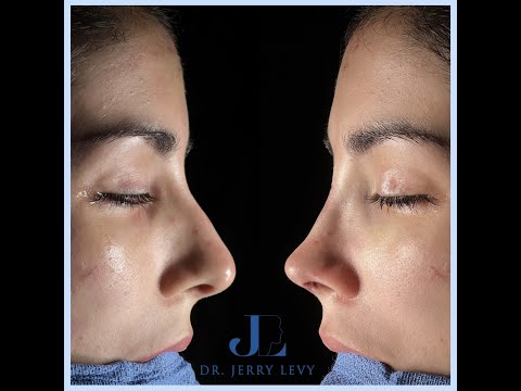 Rhinoplastie de préservation à Paris