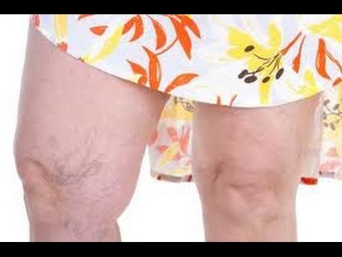 porque salen las varices porque salen las varices