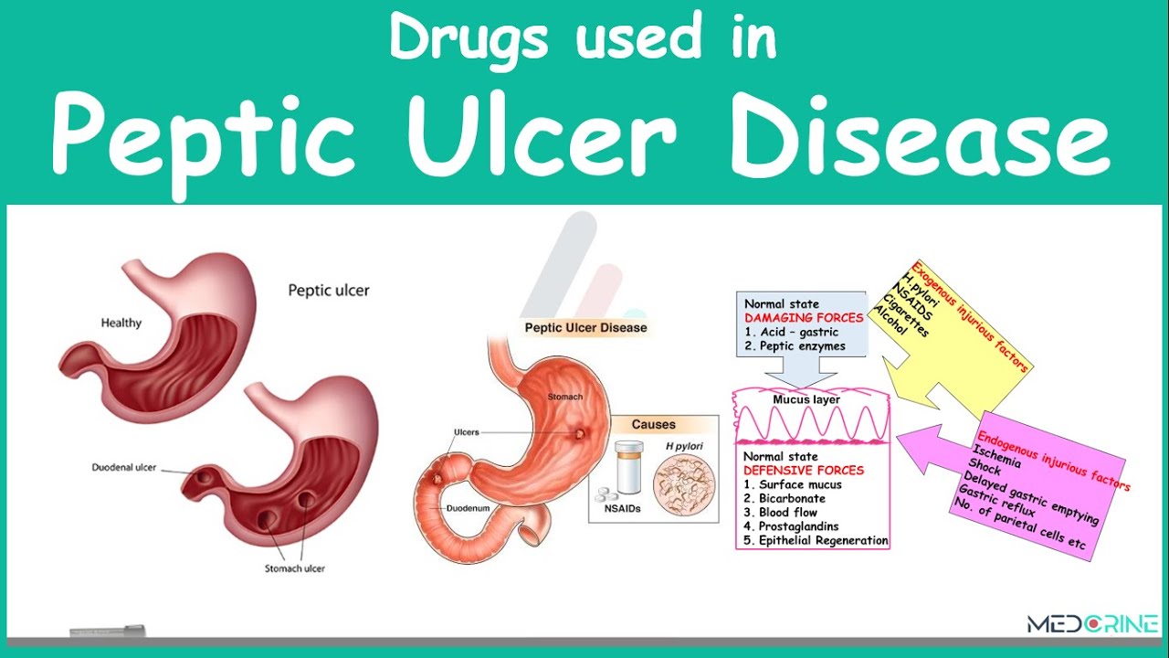 How Much Is Ulcer Drugs In Usa Drugs Used in Treament of Peptic Ulcer Diseae Pharmacology - YouTube