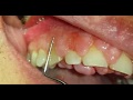 Gingivectomy for upper anteriors of Cyclosporine-induced gingival enlargement