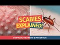 Scabies: The Disease You Should REALLY Be Worried About