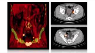 Laparoscopic Fluorescence Guidance To Sentinel Lymph Node In Prostate