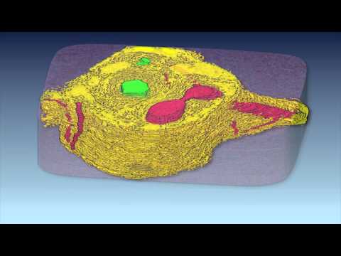 3D Reconstruction of Liver Portal Tracts From a Normal and Abnormal Dog