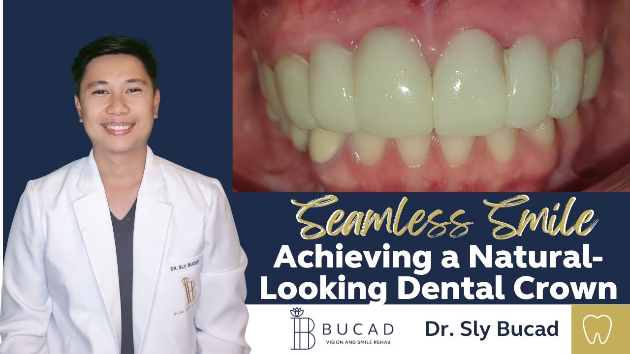 Seamless Smile With Achieving A Natural Looking Crowns Best Dental seamless-smile-with-achieving-a-natural-looking-crowns-best-dental