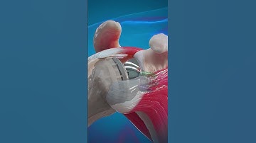 Reverse Shoulder Replacement Surgery #3danimation#ShoulderSurgery#ArthritisTreatment