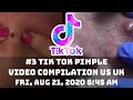 #3 TIK TOK PIMPLE VIDEO COMPILATION US UK | 21st August 2020