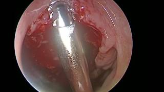 Adenoidectomy UNEDITED ( Case 3 ) - Dr. Satish Jain - www.skullbase360.in