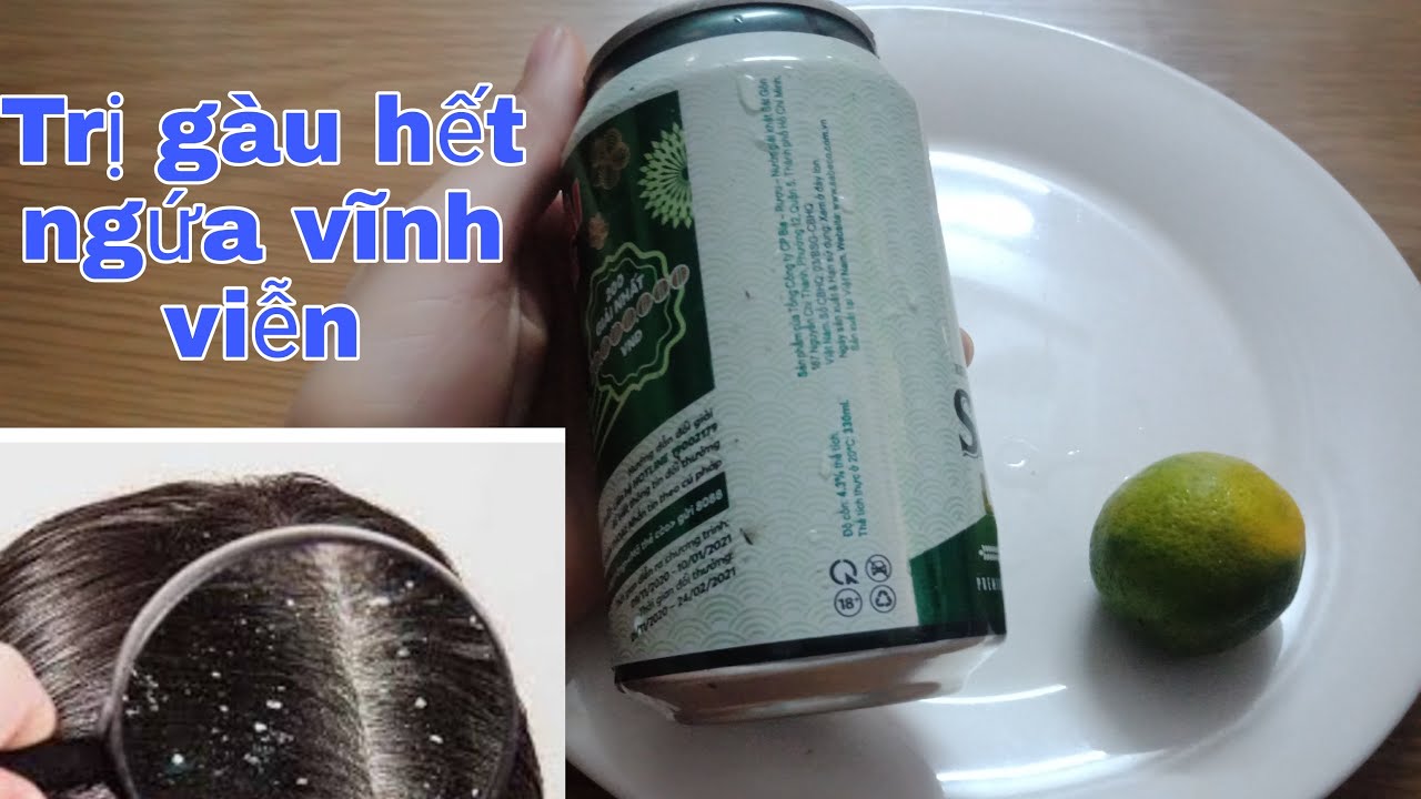 2 cách trị GÀU vĩnh viễn hết ngứa da đầu với chanh và bia | Tóm tắt các nội dung liên quan thuoc tri nam toc đầy đủ